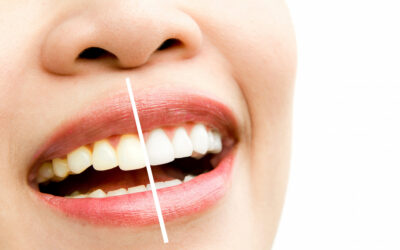 Mitos y verdades sobre el blanqueamiento dental casero